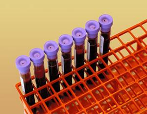 Analýza hemoglobinu v laboratoři