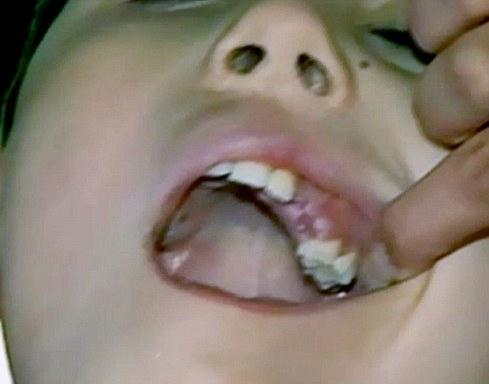 jsou ovlivněny molární zuby